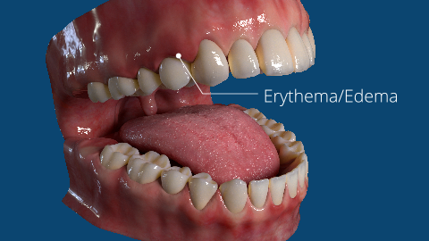 3D rendering of a human mouth with open teeth showing gums labeled "Erythema/Edema" on a blue background.