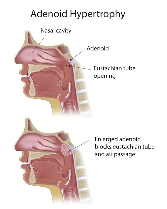 Diagram illustrating adenoid hypertrophy; shows two side views of a human head. The top image labels the nasal cavity, adenoid, and Eustachian tube opening. The bottom image shows an enlarged adenoid blocking the Eustachian tube and air passage.