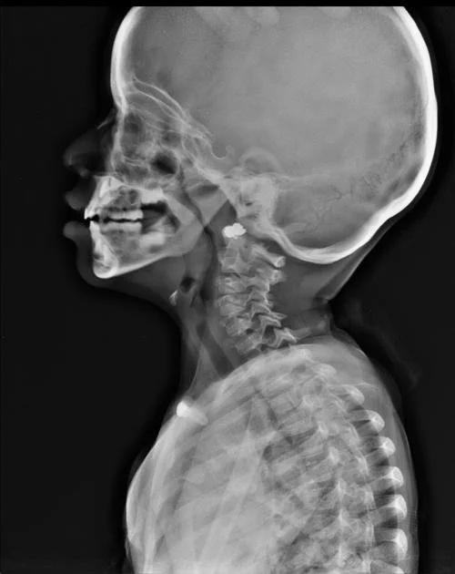 Side view of a human skull and spine X-ray, showing teeth and vertebrae.
