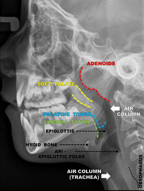 Lateral X-ray image of the head and neck showing labeled anatomical features including adenoids, soft palate, palatine tonsil, lingual tonsil, epiglottis, hyoid bone, air column, trachea, and esophagus.