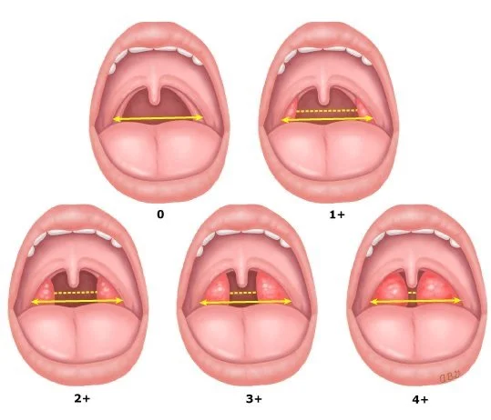 Diagram showing tonsil grading scale from 0 to 4+, illustrating varying sizes of tonsils in an open mouth view.