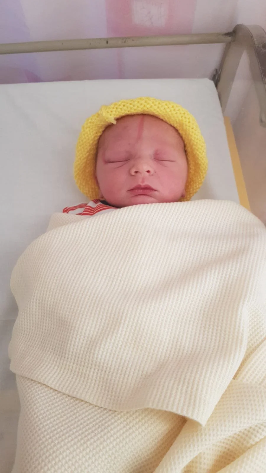 Mark on newborn's face after forceps delivery.jpg