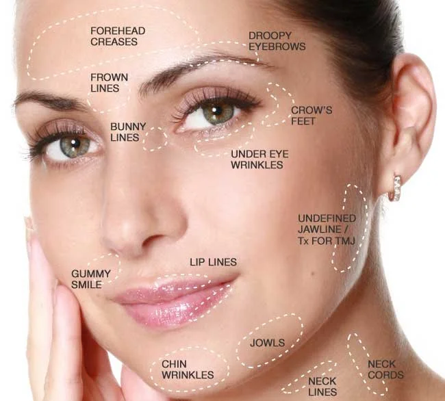 Close-up of a woman's face with dashed lines and labels pointing to various facial features indicating common cosmetic concern areas, including forehead creases, droopy eyebrows, frown lines, bunny lines, crow's feet, under eye wrinkles, undefined jawline, lip lines, gummy smile, chin wrinkles, jowls, neck lines, and neck cords.