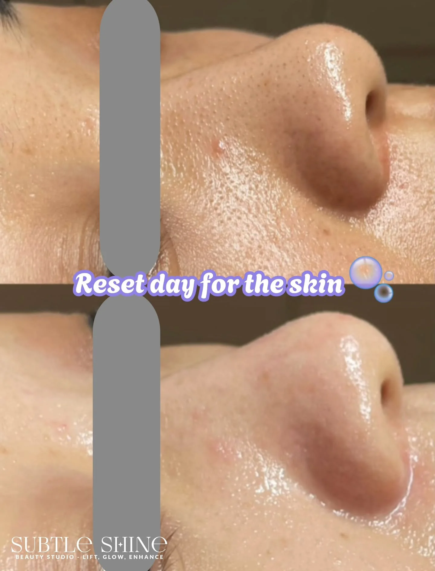 Reset day for the skin 🫧
To remove rough texture, congestion, and blackheads &mdash; HydraGlow provides a deep yet gentle cleanse that refines pores and smooths the skin without irritation.
No harsh stripping, just clean, balanced, breathable skin.
