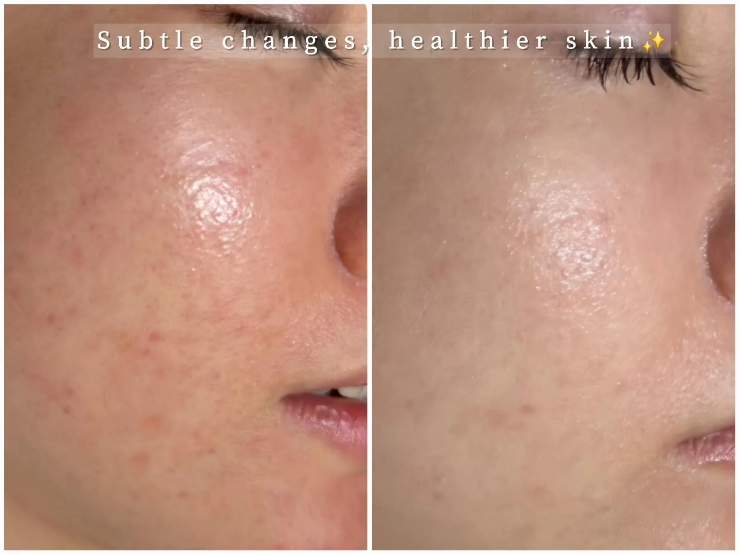 Subtle changes, healthier skin.
Just enough time before Christmas to let the skin settle.

Studio closed from 23 December for two weeks 🎄If you&rsquo;d like a facial before the holidays, booking in advance is recommended. Tap the link in bio for boo