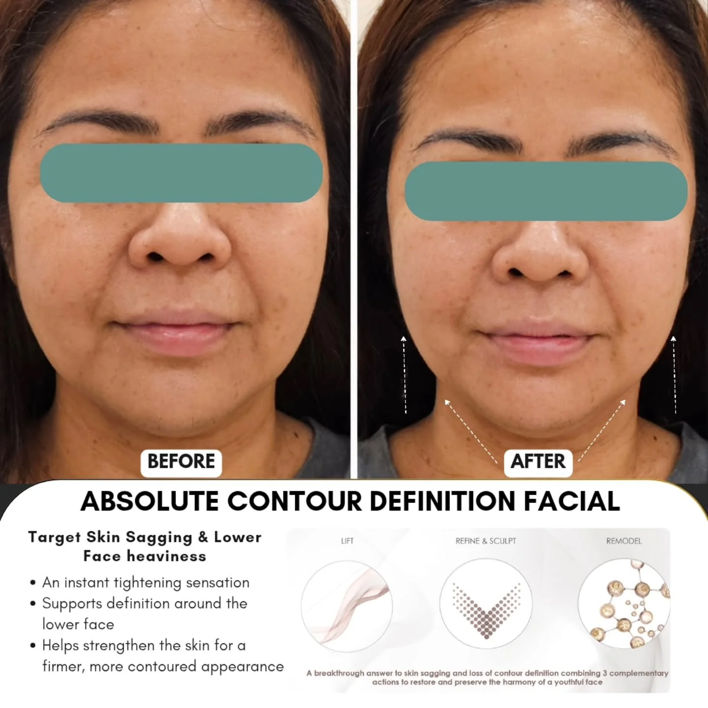 Absolute Contour Definition Facial
This treatment focuses on lower-face 
contour clarity, where heaviness and softening of facial lines commonly appear over time.

It uses a layered contour approach, combining mechanical lift support, triple ampoule 