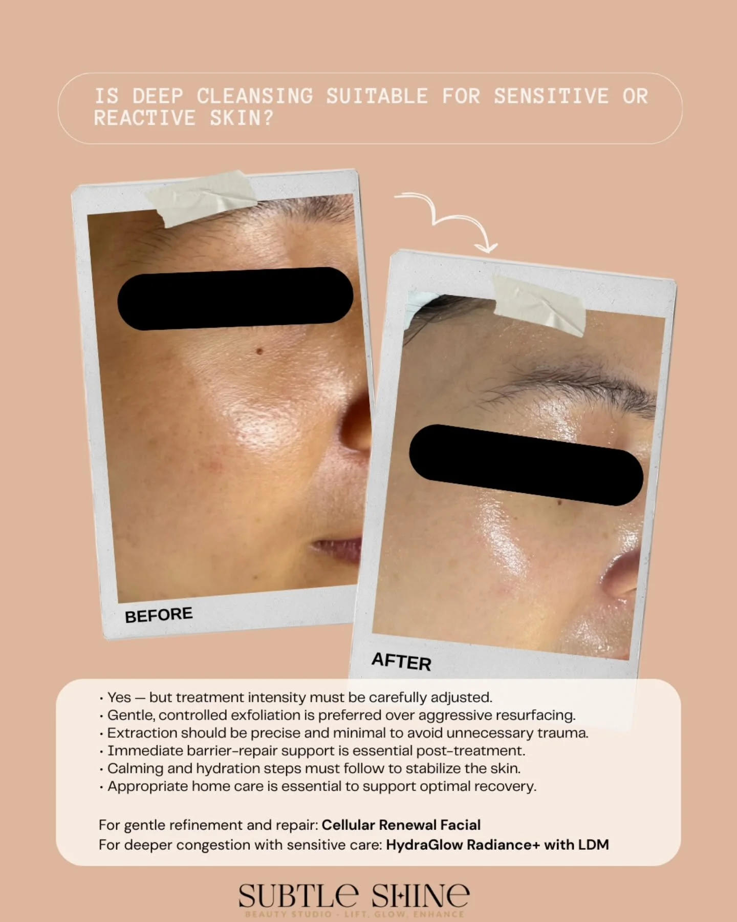 Sensitive skin does not always mean you should avoid corrective treatment.

Whether deep cleansing is suitable depends on:
&bull; How stable the skin barrier is
&bull; How much inflammation is present
&bull; The type of congestion
&bull; How well the