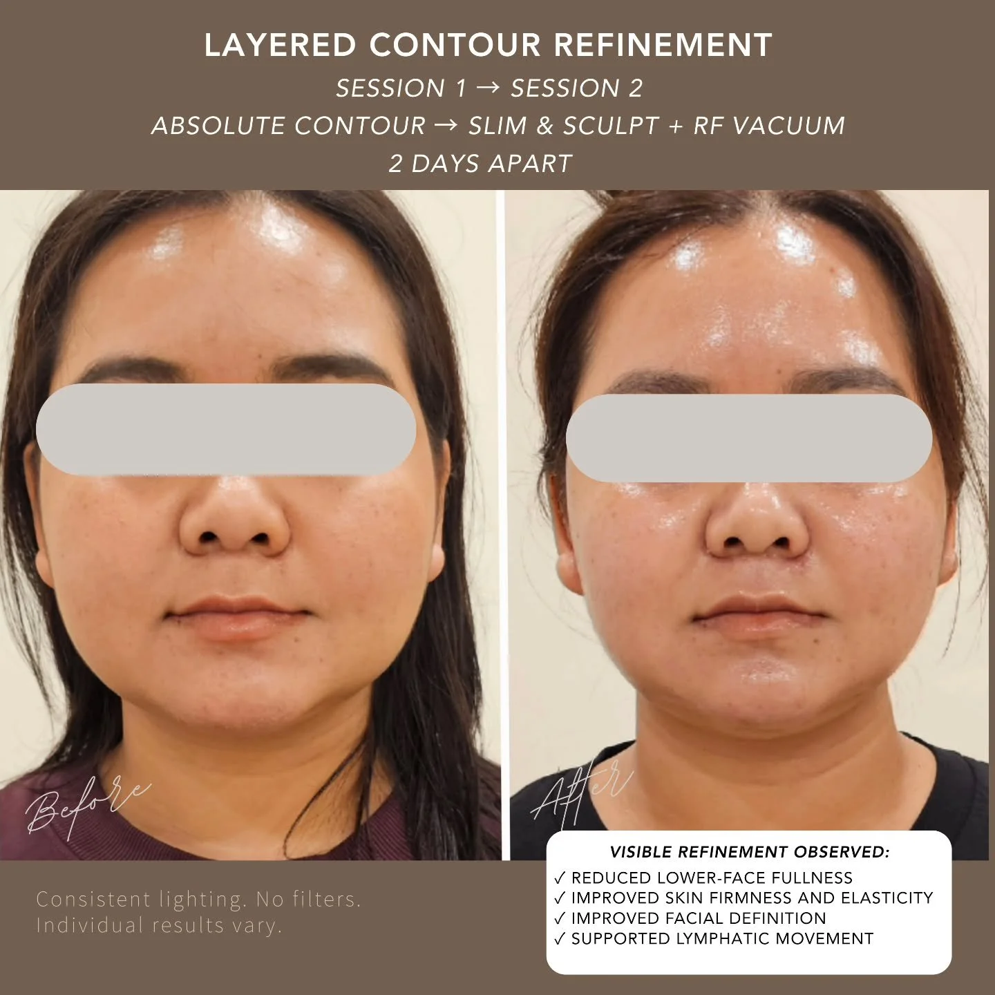 Skin firmness develops progressively.

The client in the photo completed two sessions, 2 days apart.

Treatment 1 &mdash; Absolute Contour Definition Facial
Focused on strengthening the skin&rsquo;s foundation, improving density, and refining overall