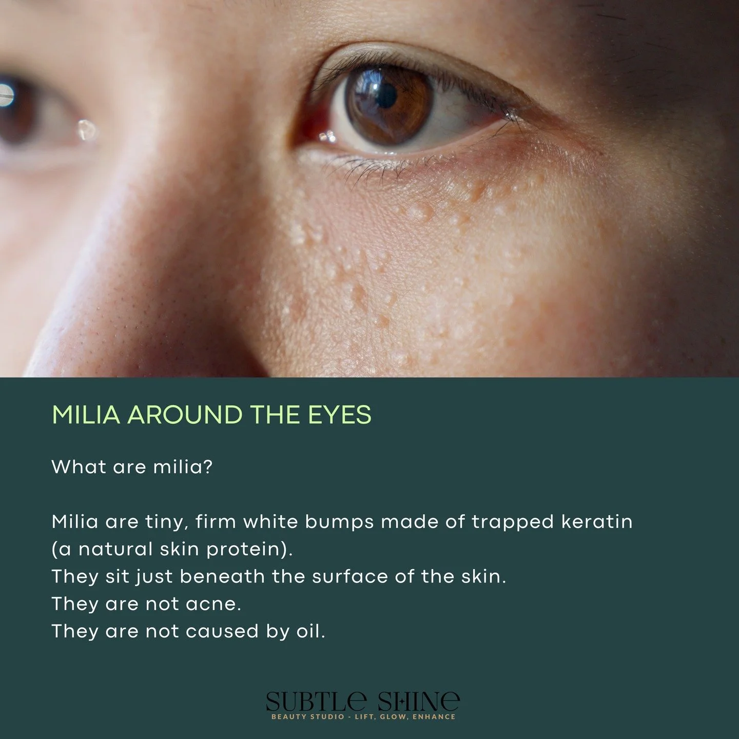 Those tiny white bumps around the eyes are often misunderstood.

Milia are keratin-filled cysts &mdash; not clogged pores and not caused by excess oil. Because they are enclosed beneath the surface, they cannot be squeezed out like acne. Attempting t