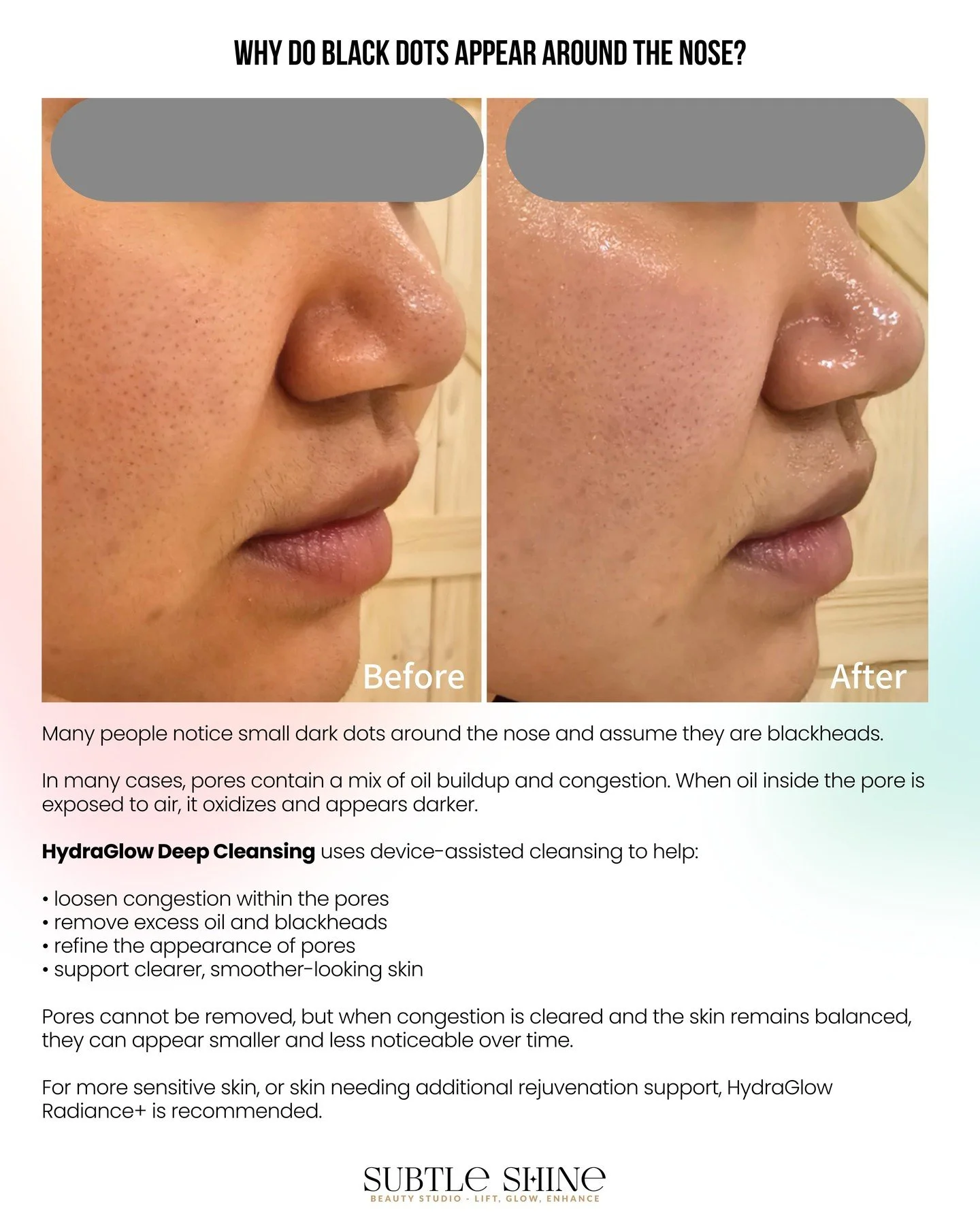 Blackheads or Something Else?

Understanding the Dark Dots on Your Nose

Many people notice small dark dots around the nose and assume they are blackheads. However, this is not always the case.

In many situations, these dots are oil inside the pores
