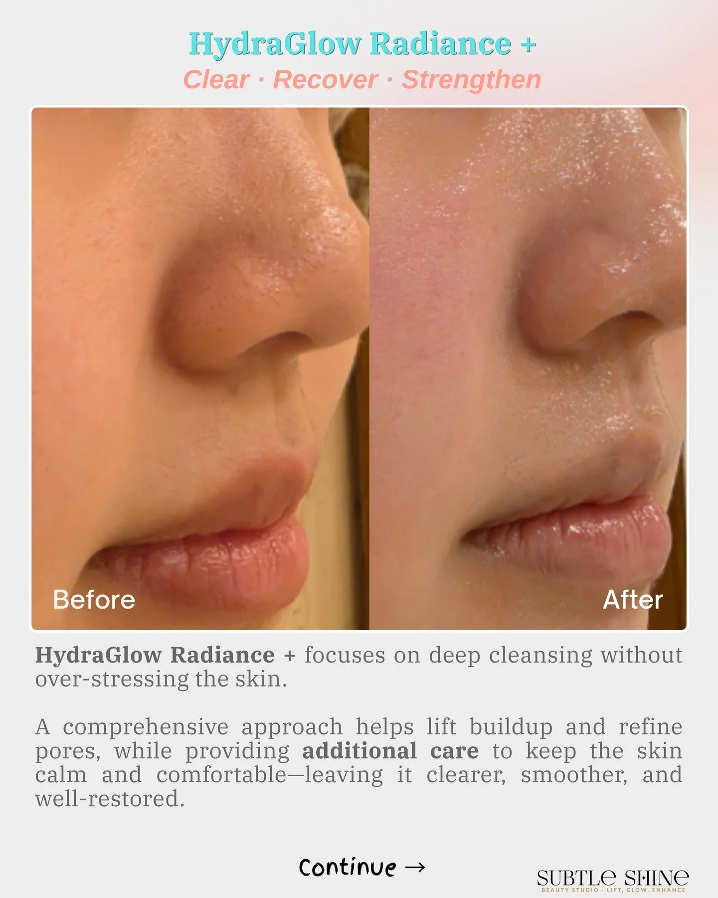 Do you know deep cleansing can affect how your skin cells stay connected?

It&rsquo;s not just about removing buildup.
The way the skin is treated during the process can influence its stability, moisture balance, and how reactive it becomes afterward
