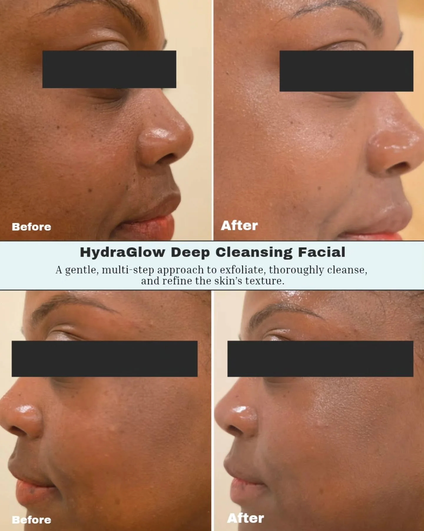 One session to remove what travel leaves behind - and remind your skin what it feels like to breathe again.

Link in bio to book.

#SkinReset #TravelSkin #DeepCleanseFacial #kbeautyfacial #hydrafacial
