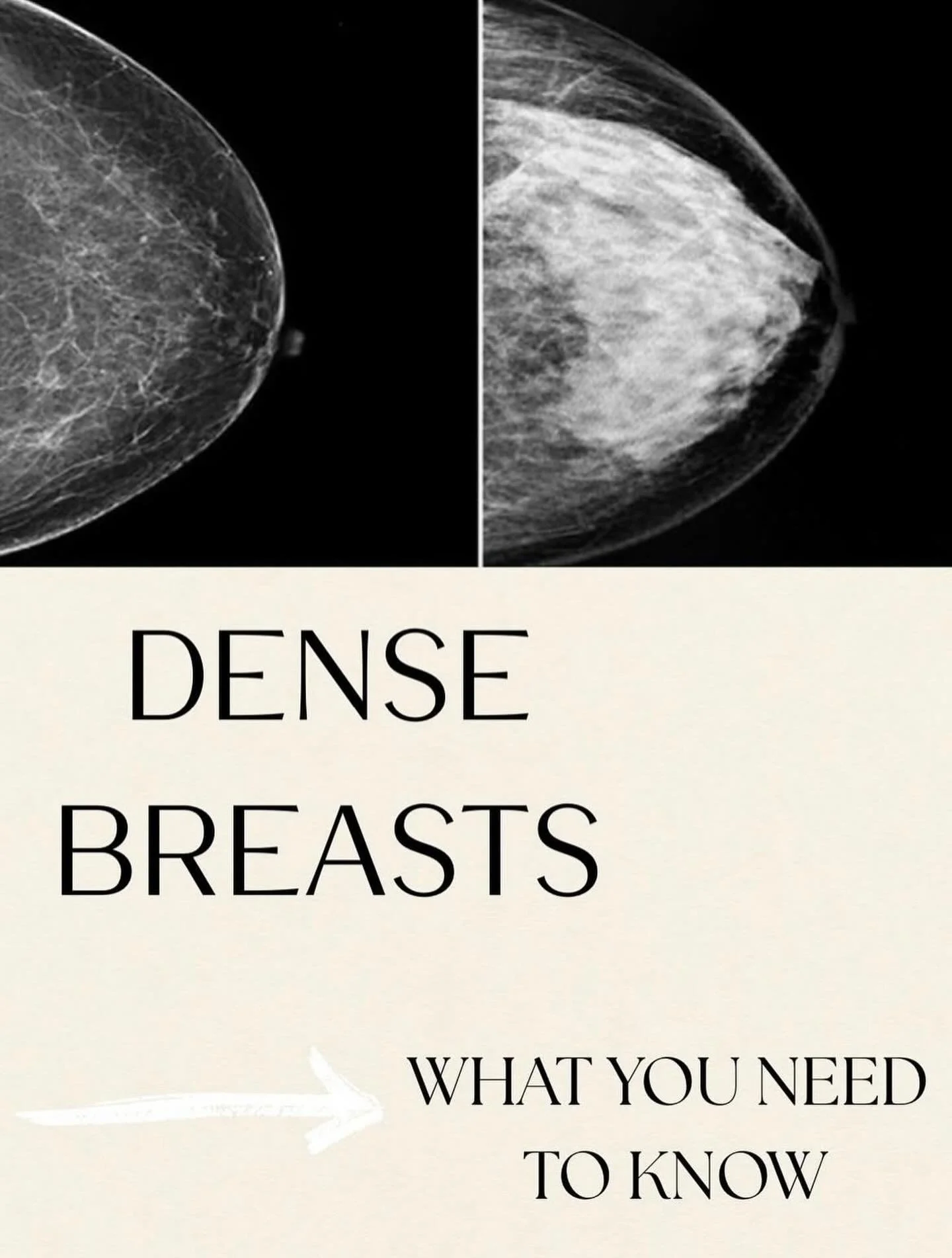 Do you know your breast density? 
It&rsquo;s important to know because small masses may be more difficult to find and may increase your risk of developing breast cancer. Ultrasound is routinely used to complement mammography, further increasing the c