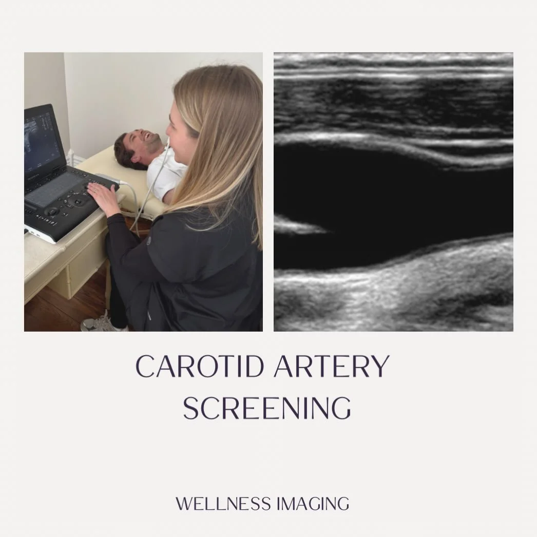 February is National Heart Month ❤️
A yearly carotid artery screening can help detect plaque buildup early and reduce your risk of stroke. Early detection saves lives. 
Schedule your screening today and put your health first.

Www.wellnessultrasound.