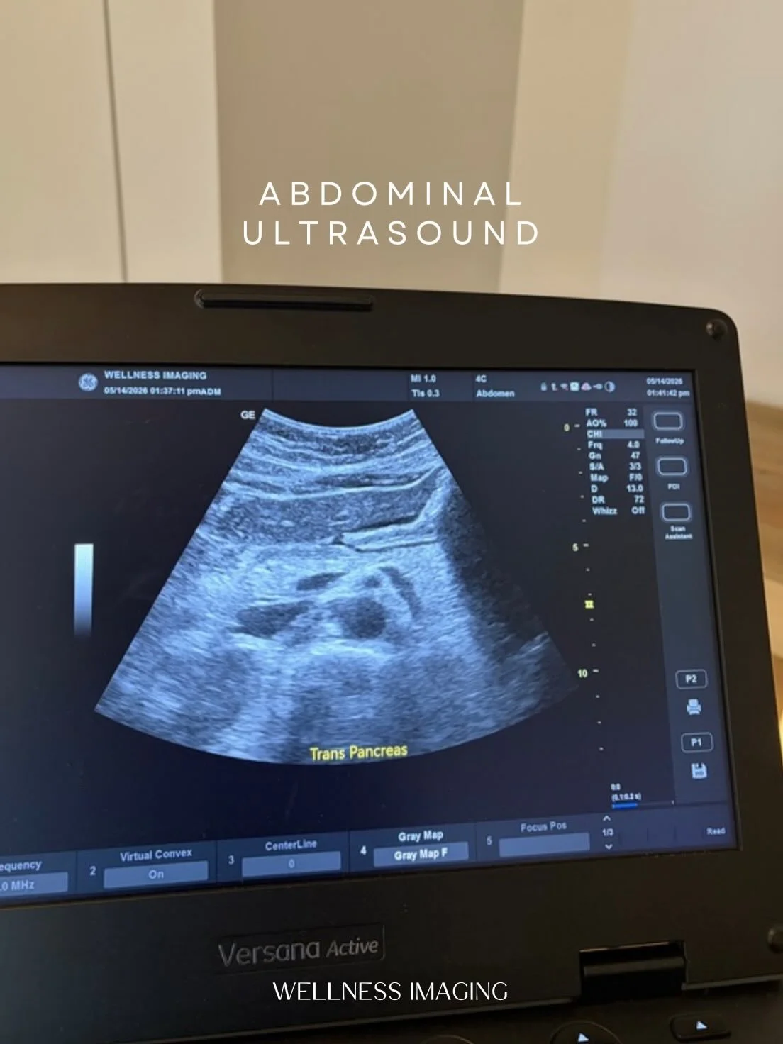 An abdominal screening ultrasound is a simple, non-invasive way to take a closer look at important organs and structures in the abdomen. This screening may help identify concerns early, including:

&bull; Abdominal aortic aneurysm 
&bull; Liver abnor