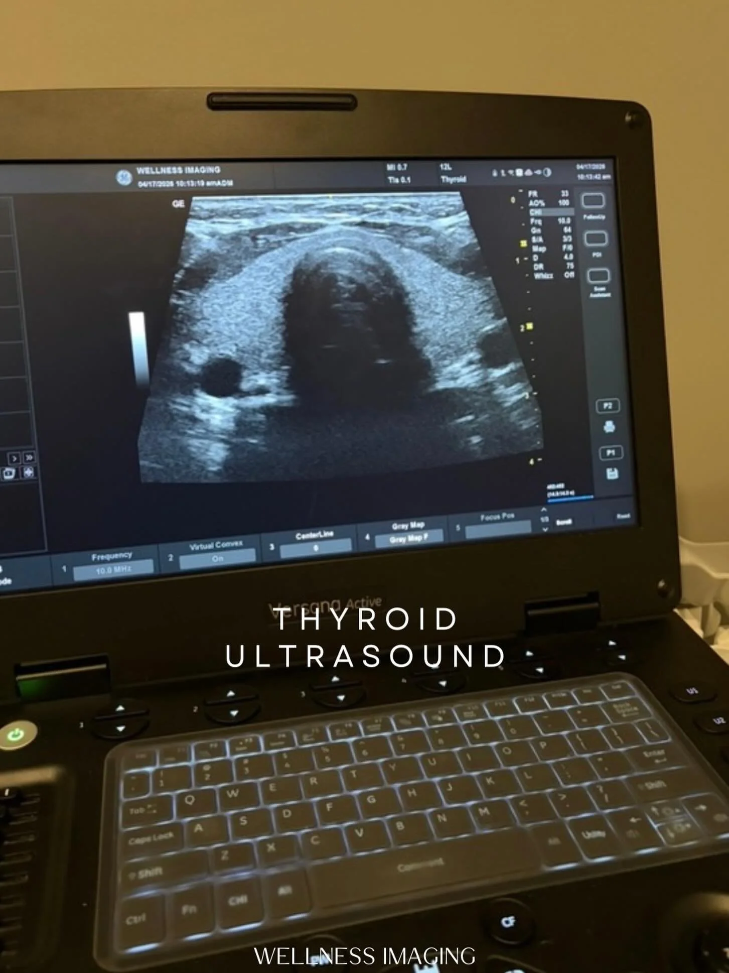 Thyroid nodules are incredibly common and most are harmless. But some can be cancerous or cause issues even when your hormone levels are perfectly normal.

Thyroid ultrasound is used to evaluate thyroid size, nodules, and suspicious growths.

Blood t