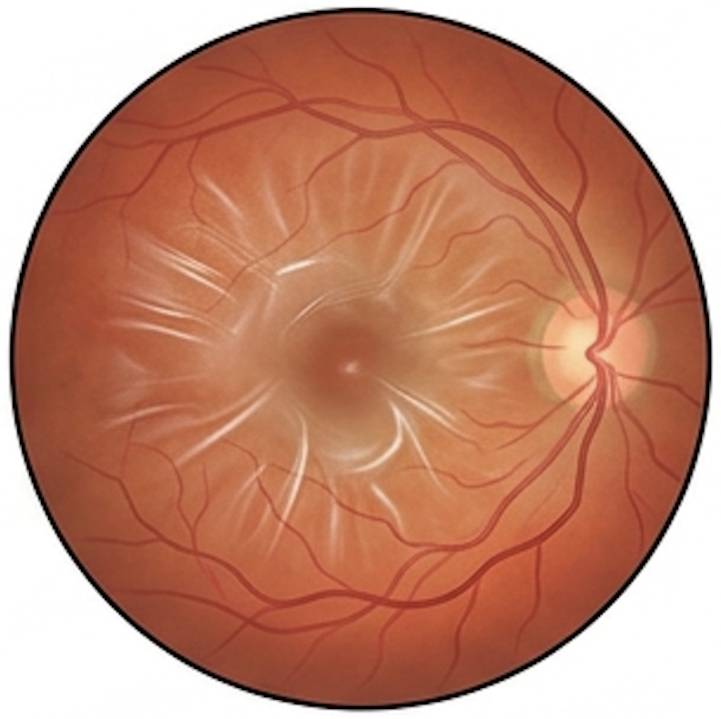 Epiretinal membrane