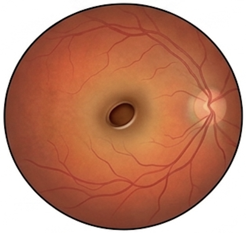 Macular hole