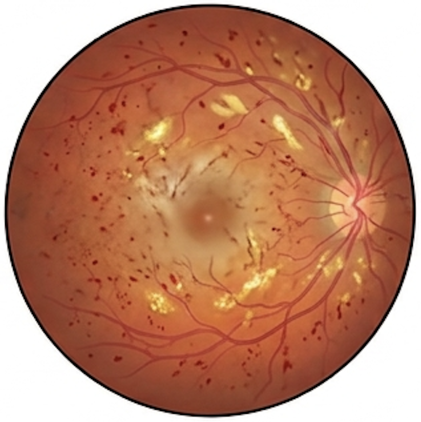 Diabetic retinopathy