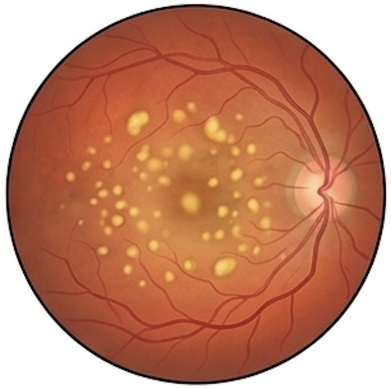 Macular degeneration