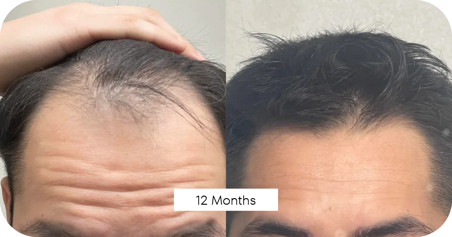 La Dermalogique Hairline Before After 1.png