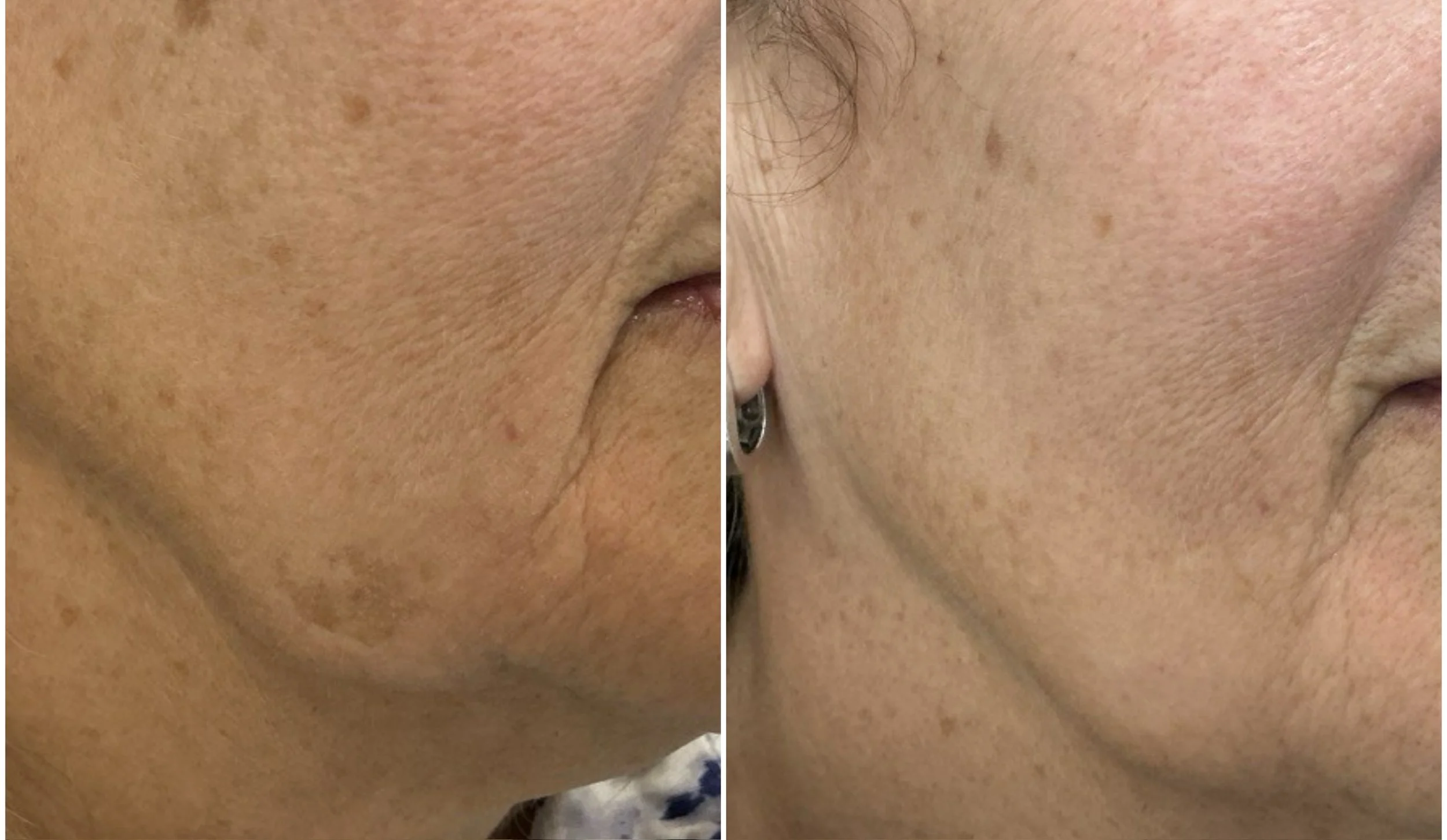 Catalyst Medspa patient before and after of brown age spots on the face showing great improvement with IPL