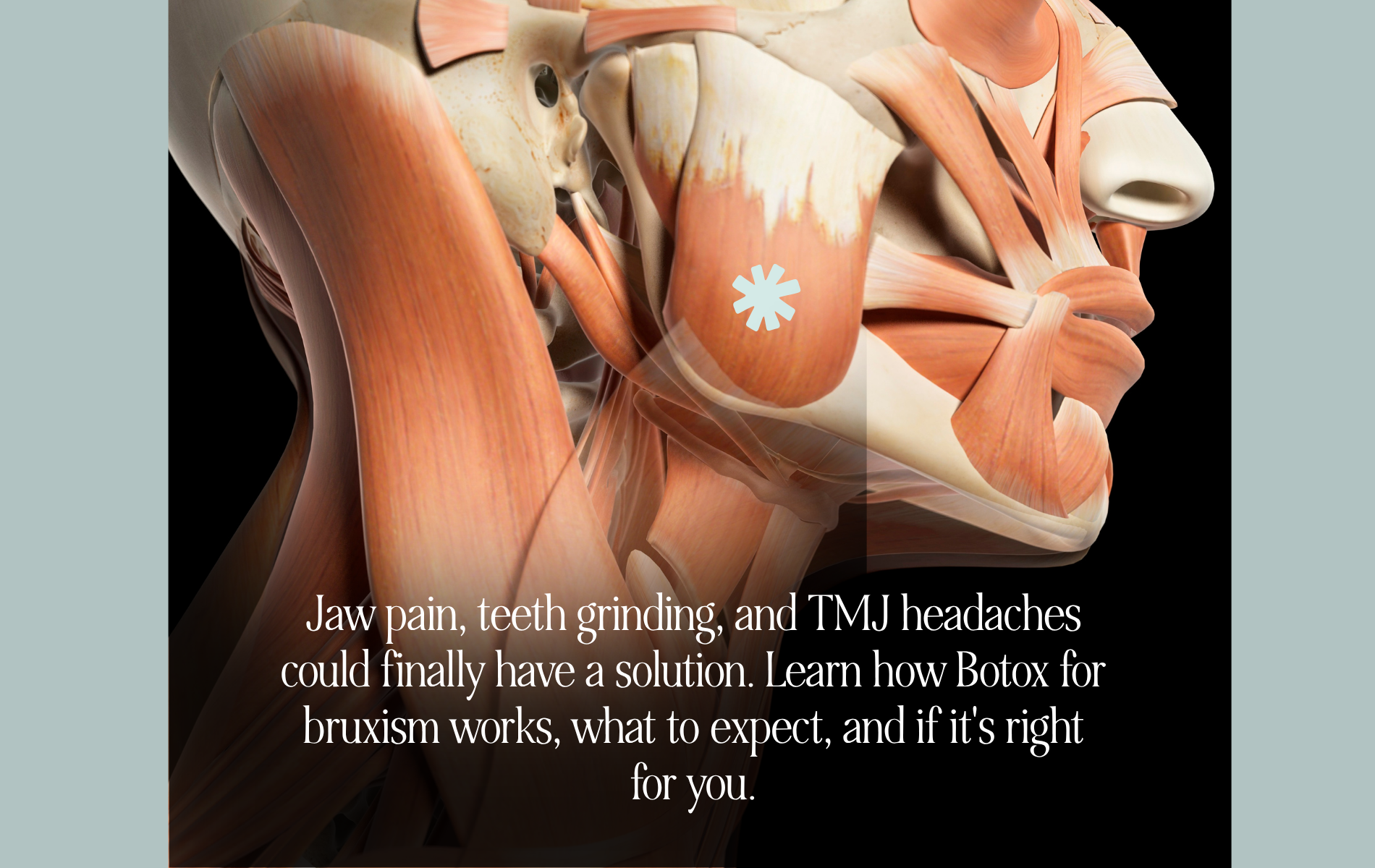 This is a graphic showing the muscles of the jaw and face with an Asterix on the masseter muscle