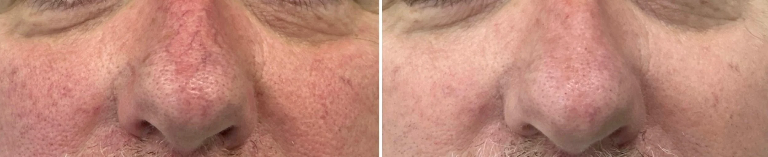 Man with redness and facial vessels before and after IPL