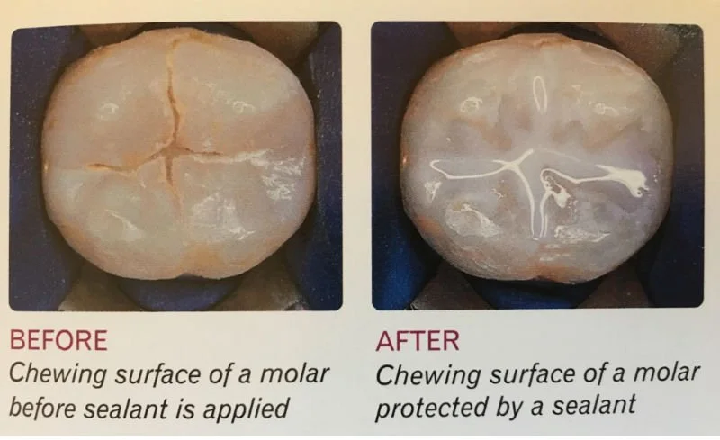 Sealants — Winning with Smiles