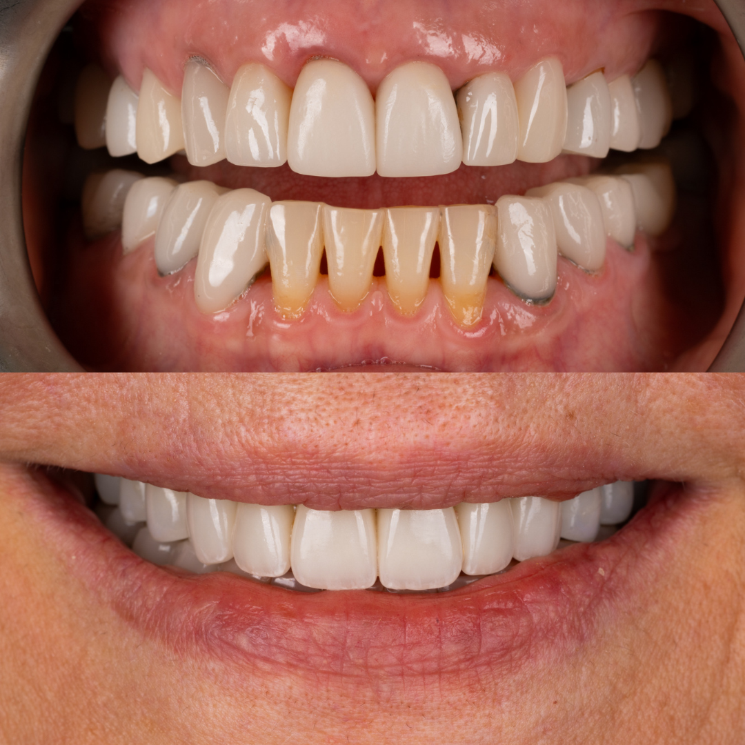 Porcelain ceramic crowns veneers implants smile makeover by Dr. Tammy Bui, a reconstructive and aesthetic dentist serving Irvine and Dana Point in Orange County, California.