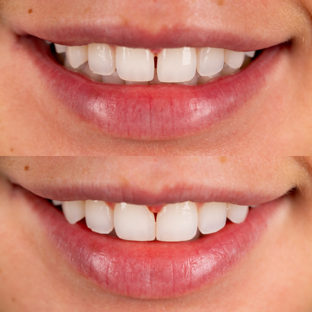 Diastema closure with composite bonding by Dr. Tammy Bui, a reconstructive and aesthetic dentist serving Irvine and Dana Point in Orange County, California.