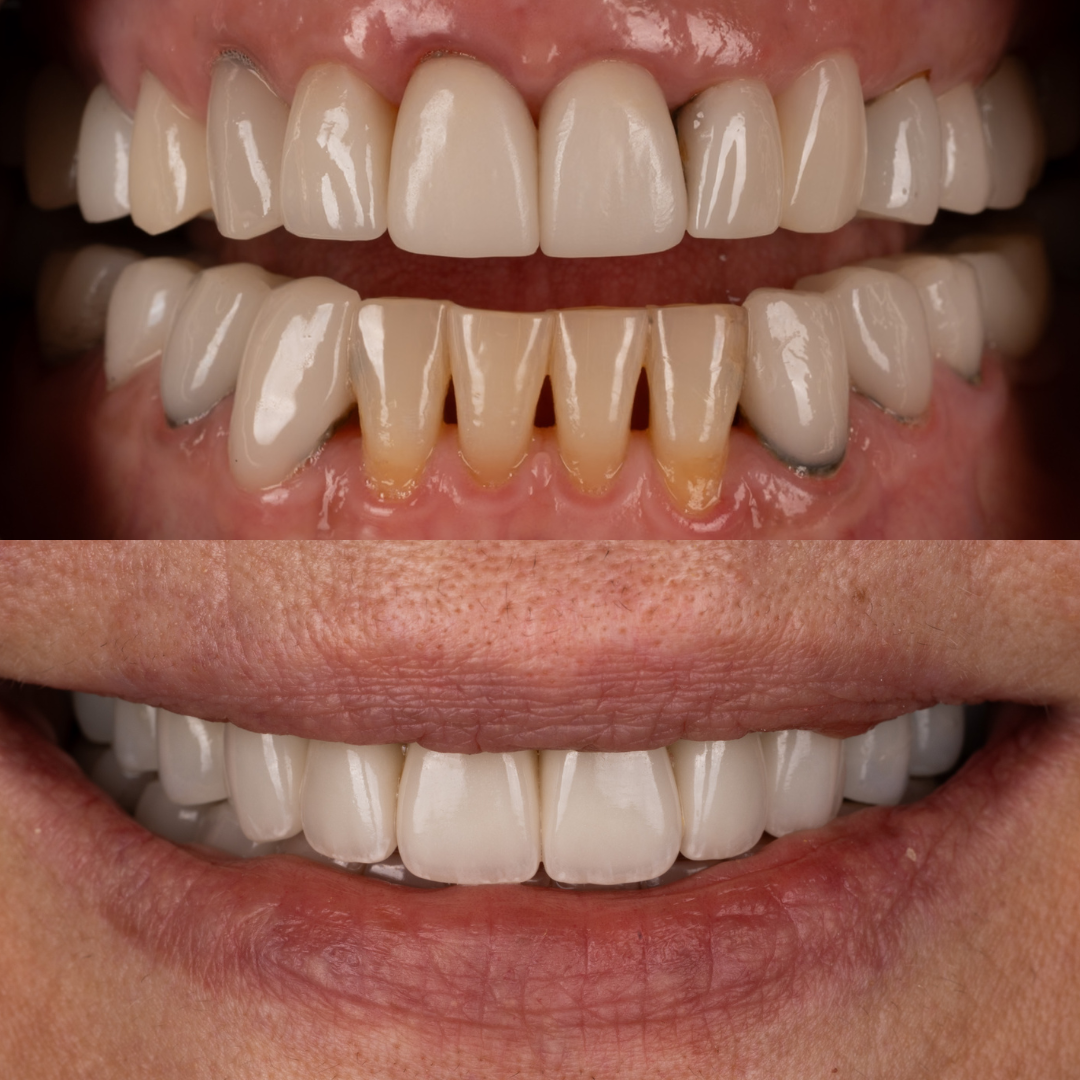 Comparison of teeth before and after dental treatment, showing improved dental appearance and whitening.