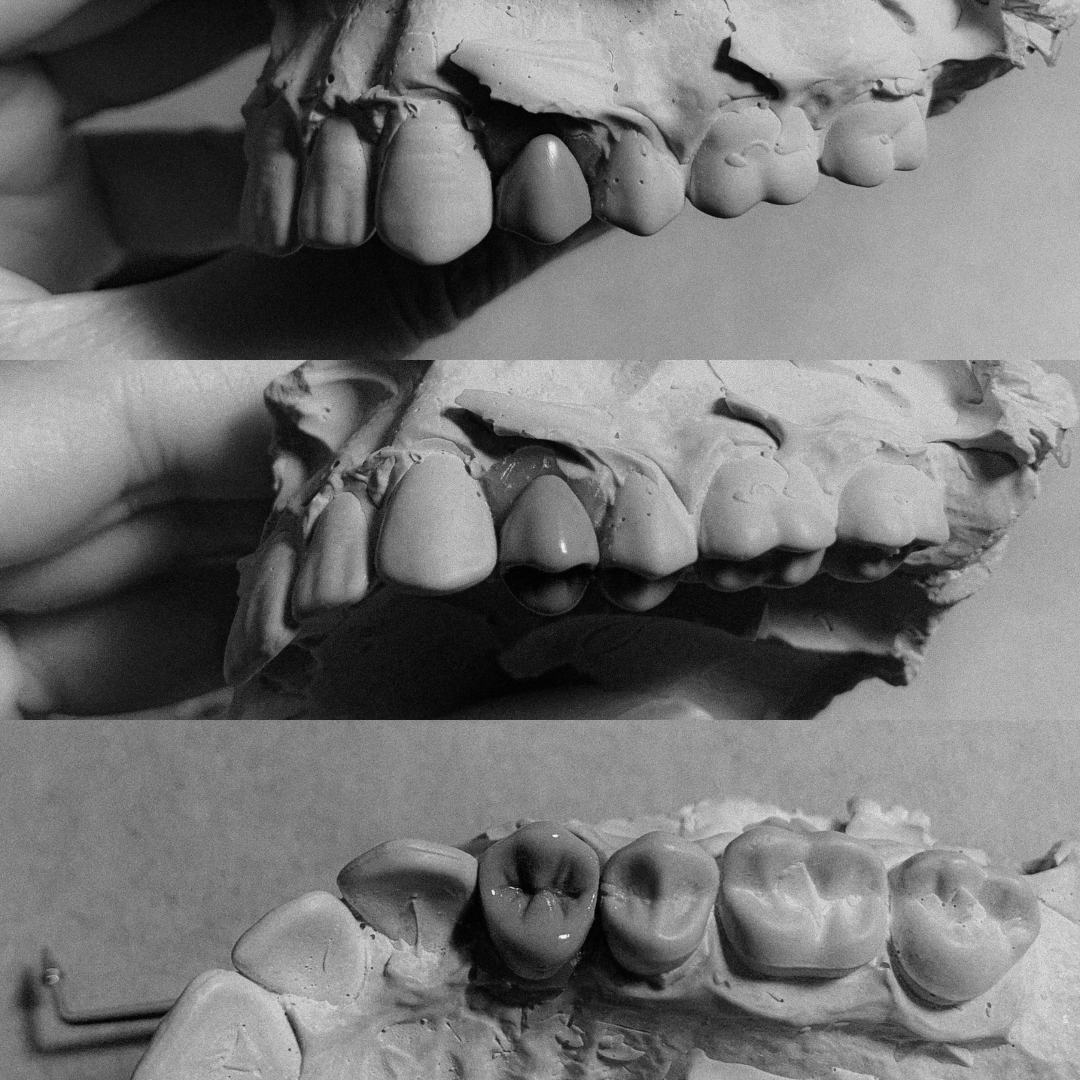 Black and white photo showing three different views of dental models with teeth.