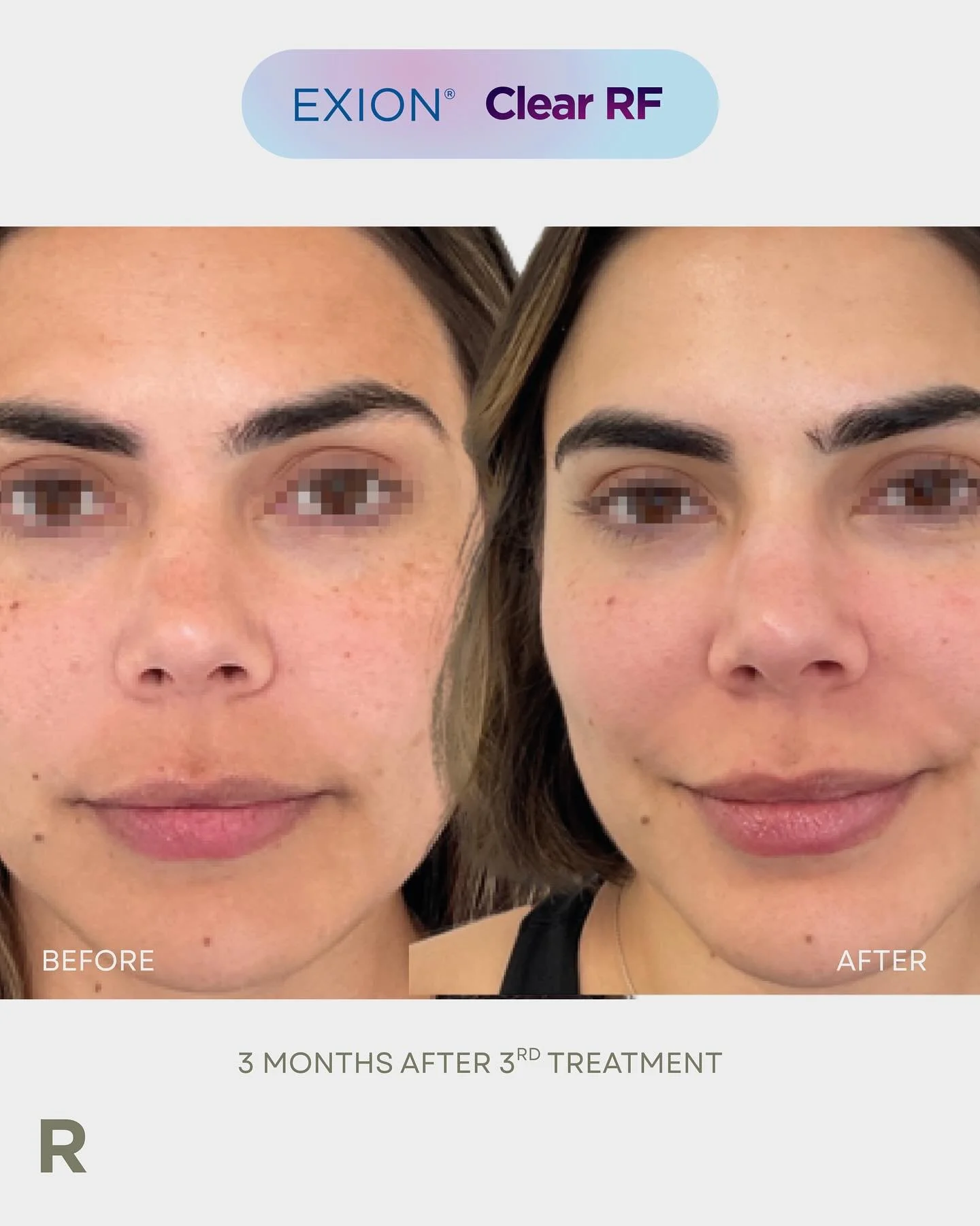 Discover EXION CLEAR RF for pigmentation at Renew Skin Clinics 
π₯ http://www.renewskinclinics.com.au
π§ hello@renewskinclinics.com.au
π 03 9467 2220
π Greensborough, VIC