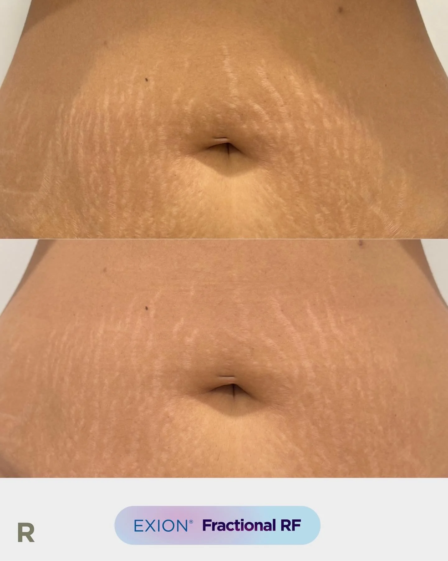 EXION Fractional RF Needling

See the improvement after just one session for post-pregnancy stretch marks. This treatment uses a combination of radiofrequency energy and precise needling to rebuild and strengthen the skin from within.

Fractional RF 