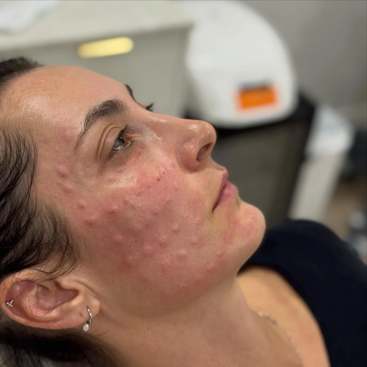 Rejuran full face treatment is the ultimate skin reset for the festive season
Powered by polynucleotides to deeply repair, hydrate and strengthen the skin from within, improving texture, tone and overall radiance

Perfect if your skin is feeling tire