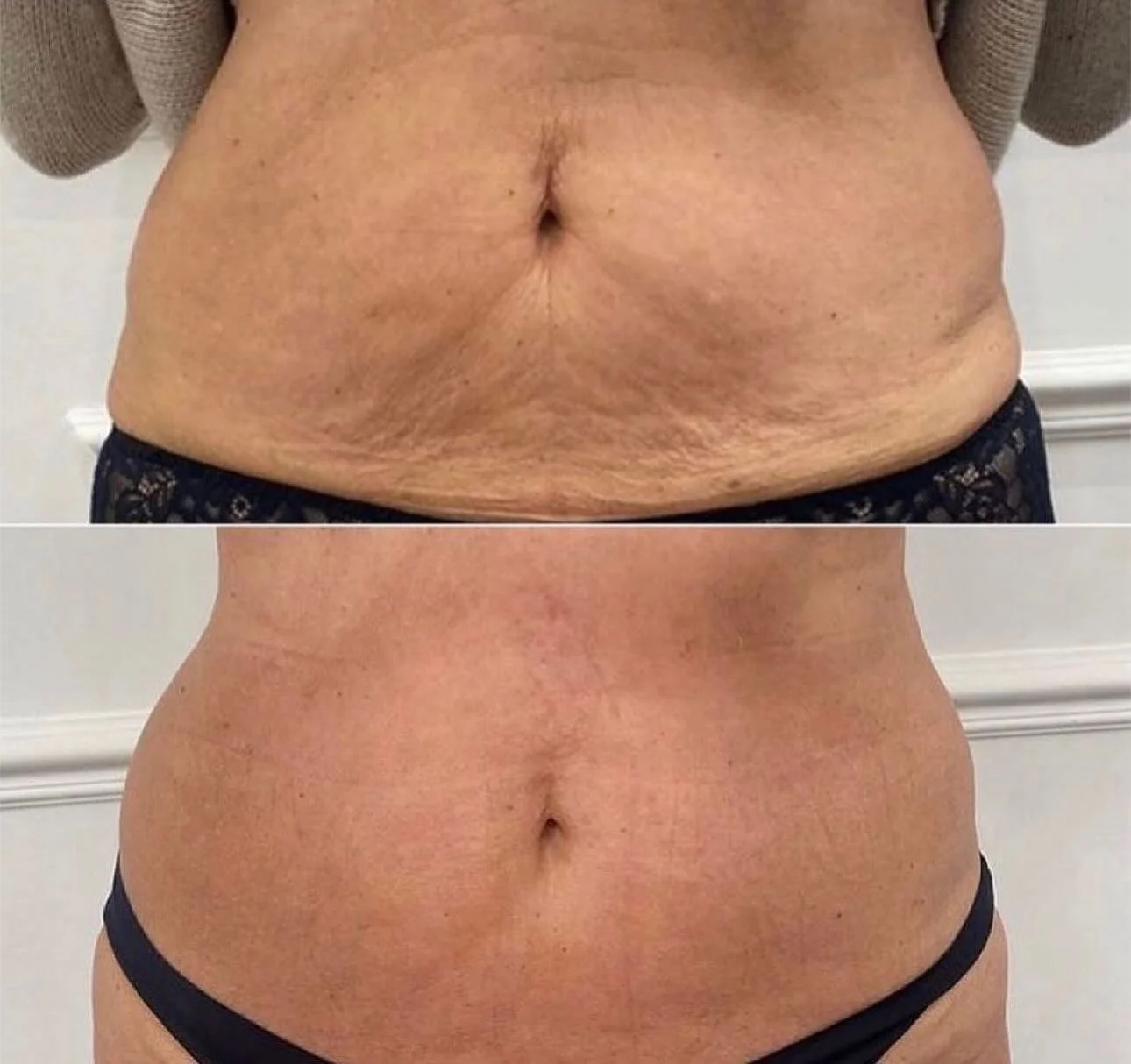 ✨ Skin tightening results after 4 sessions ✨

Before &rarr; After 
Exion RF Needling working its magic on laxity, texture, and overall skin quality.

This treatment combines radiofrequency with microneedling to stimulate collagen and elastin deep wit