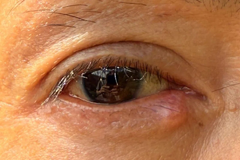 Menopause and Dry Eyes&nbsp;