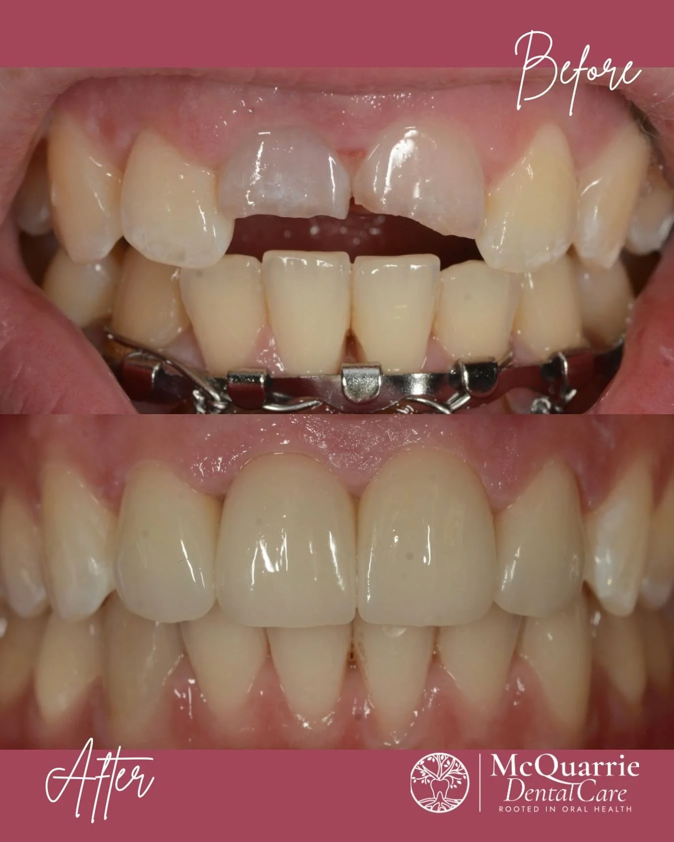 From accident to a healthy smile- restored with precision, care, and a little love this Valentine&rsquo;s Day. 🦷✨