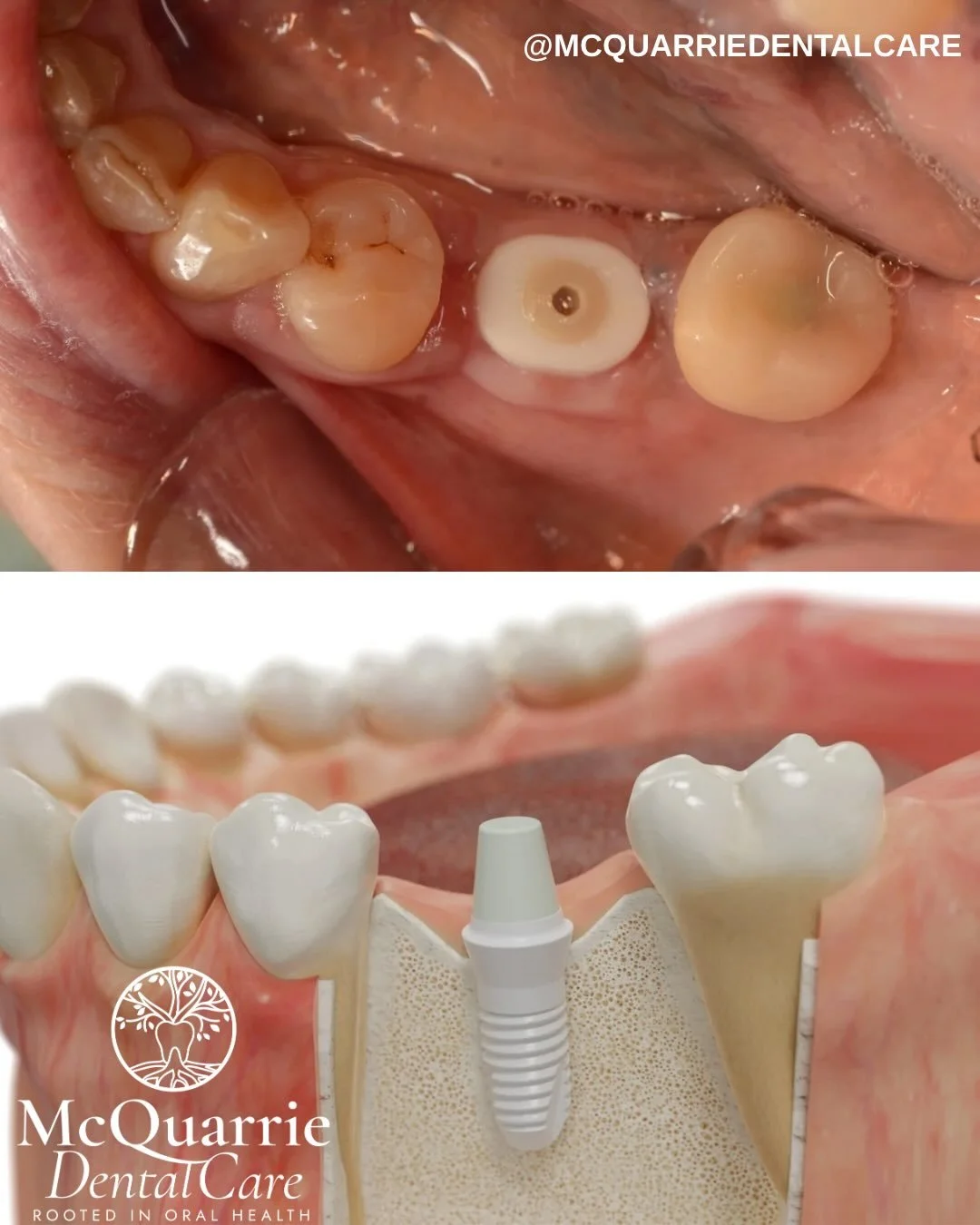 Strong. Natural. Long-lasting. 🦷

In our newest blog post, we&rsquo;re breaking down everything you need to know about zirconia crowns &mdash; from durability and aesthetics to why they&rsquo;re one of today&rsquo;s most trusted restorative options.