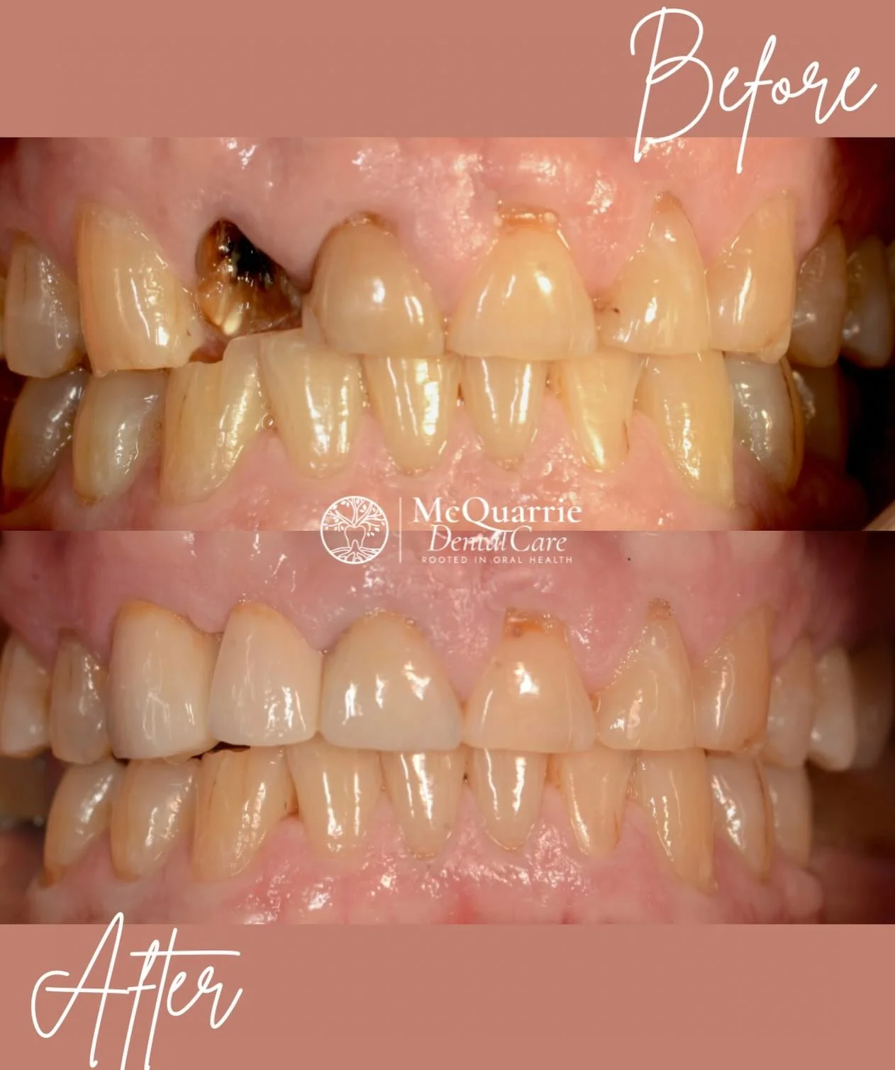 This space is no longer available. 😉 🦷

Extraction ➡️ Bridge ➡️ smile upgrade