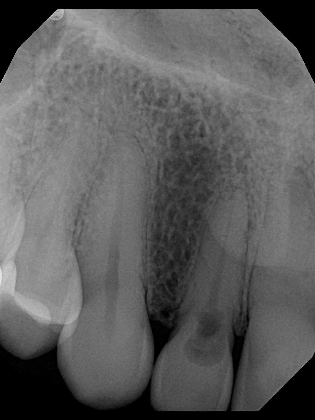 What started as internal resorption ultimately led to the need for a dental implant &mdash; a reminder of how important early diagnosis and routine dental visits truly are.

Internal resorption is often silent, progressive, and can compromise the str