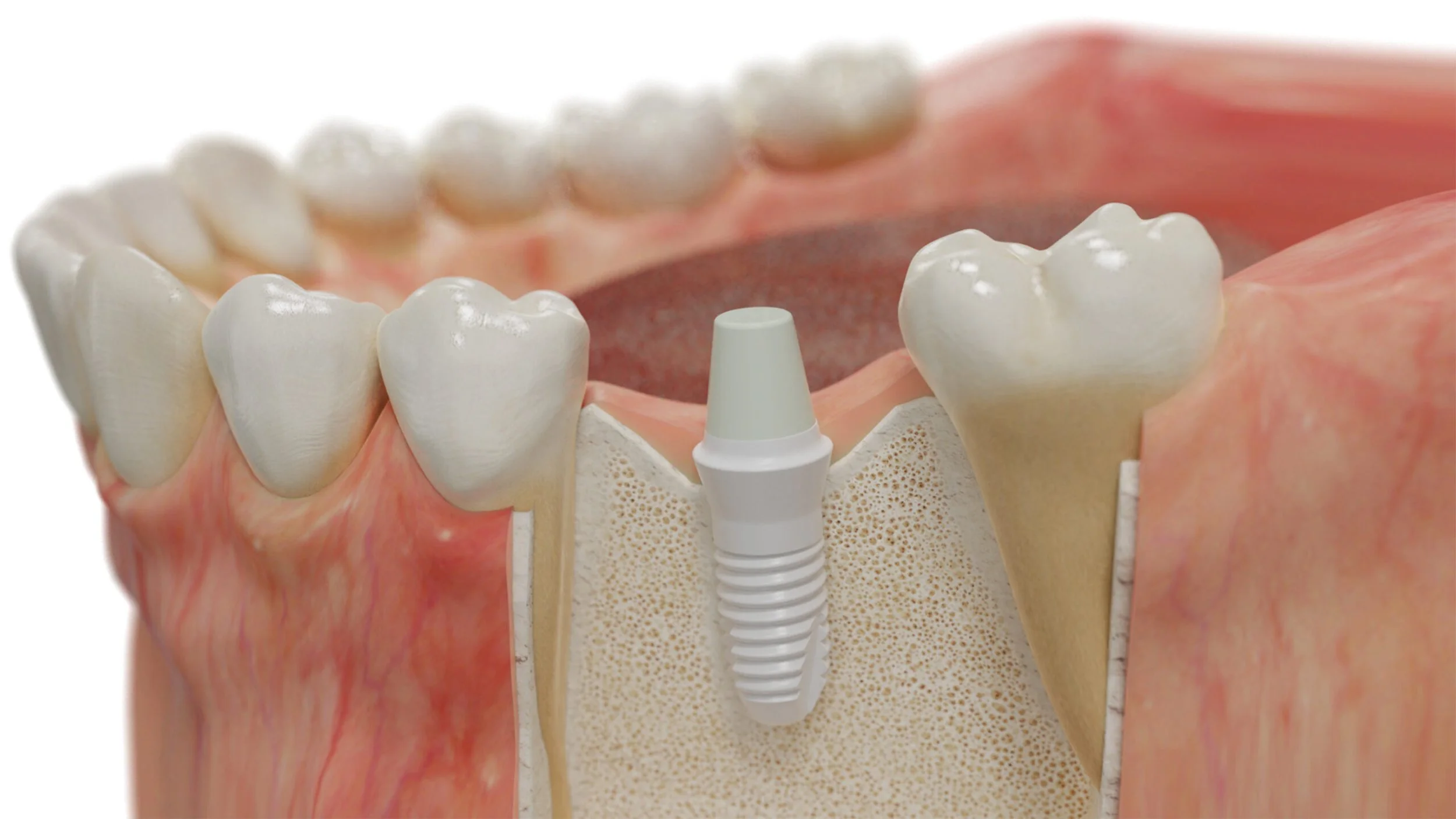 zirconia ceramic dental implant