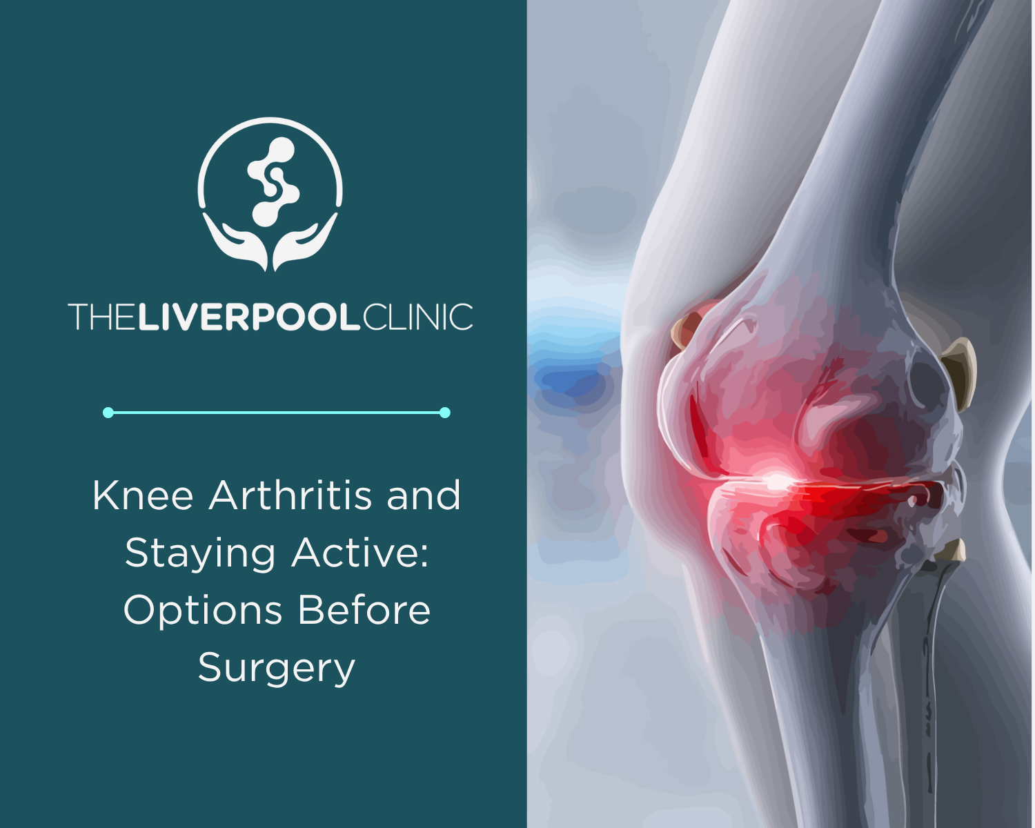 Knee Arthritis and Staying Active: Options Before Surgery