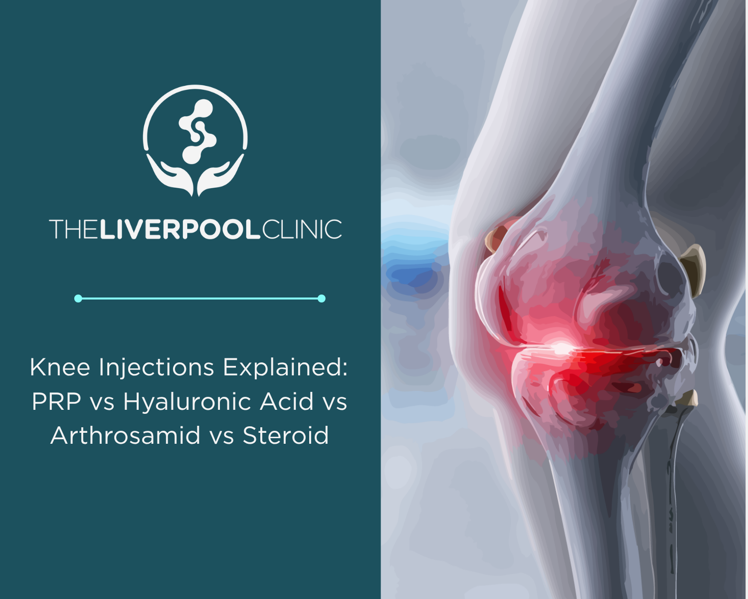 Knee Injections Explained: PRP vs Hyaluronic Acid vs Arthrosamid vs Steroid