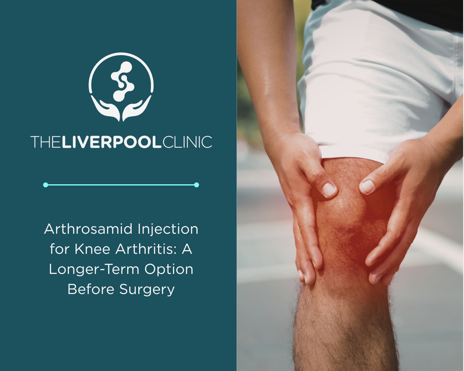 Arthrosamid Injection for Knee Arthritis: A Longer-Term Option Before Surgery