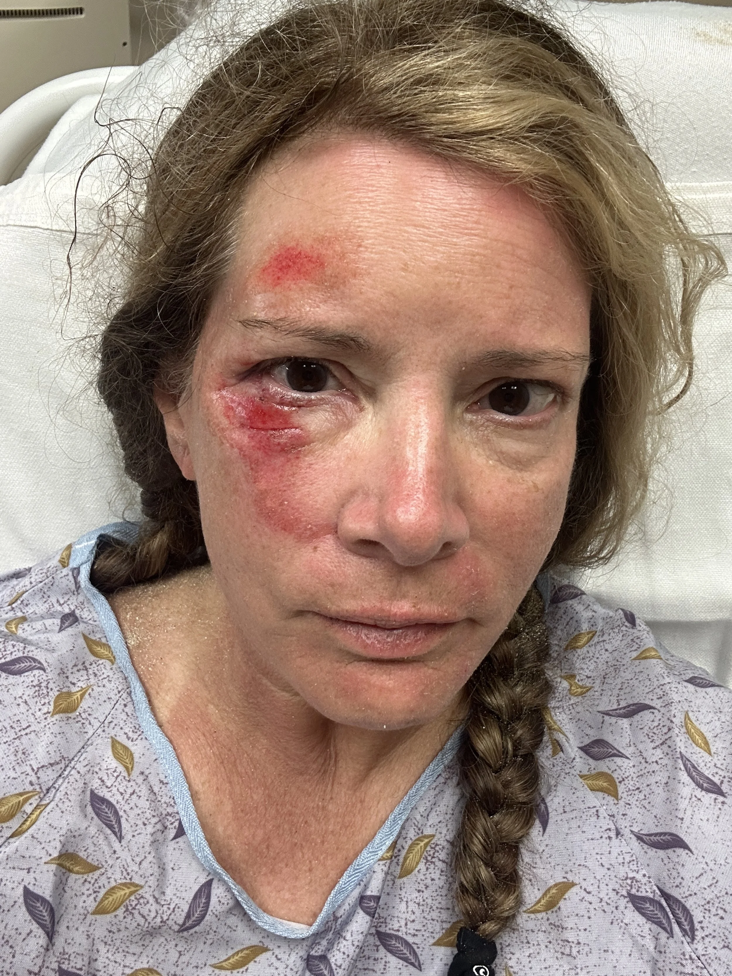Facial abrasions after wave injury, photographed in the emergency room before using tallow cream.