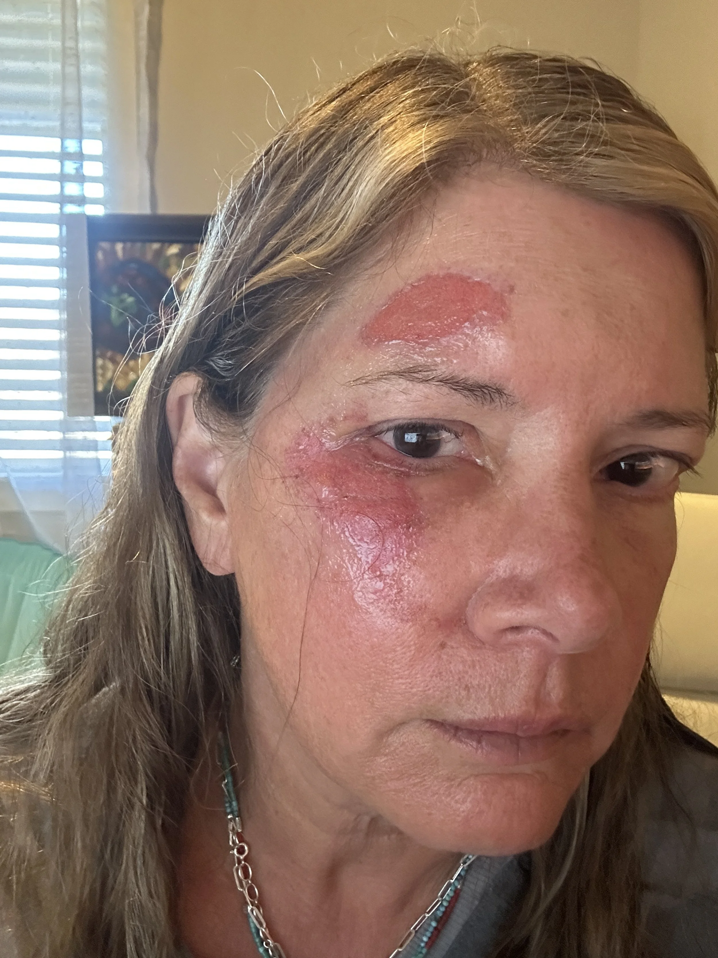 Visible facial healing progress by day three using tallow face cream on abrasions.