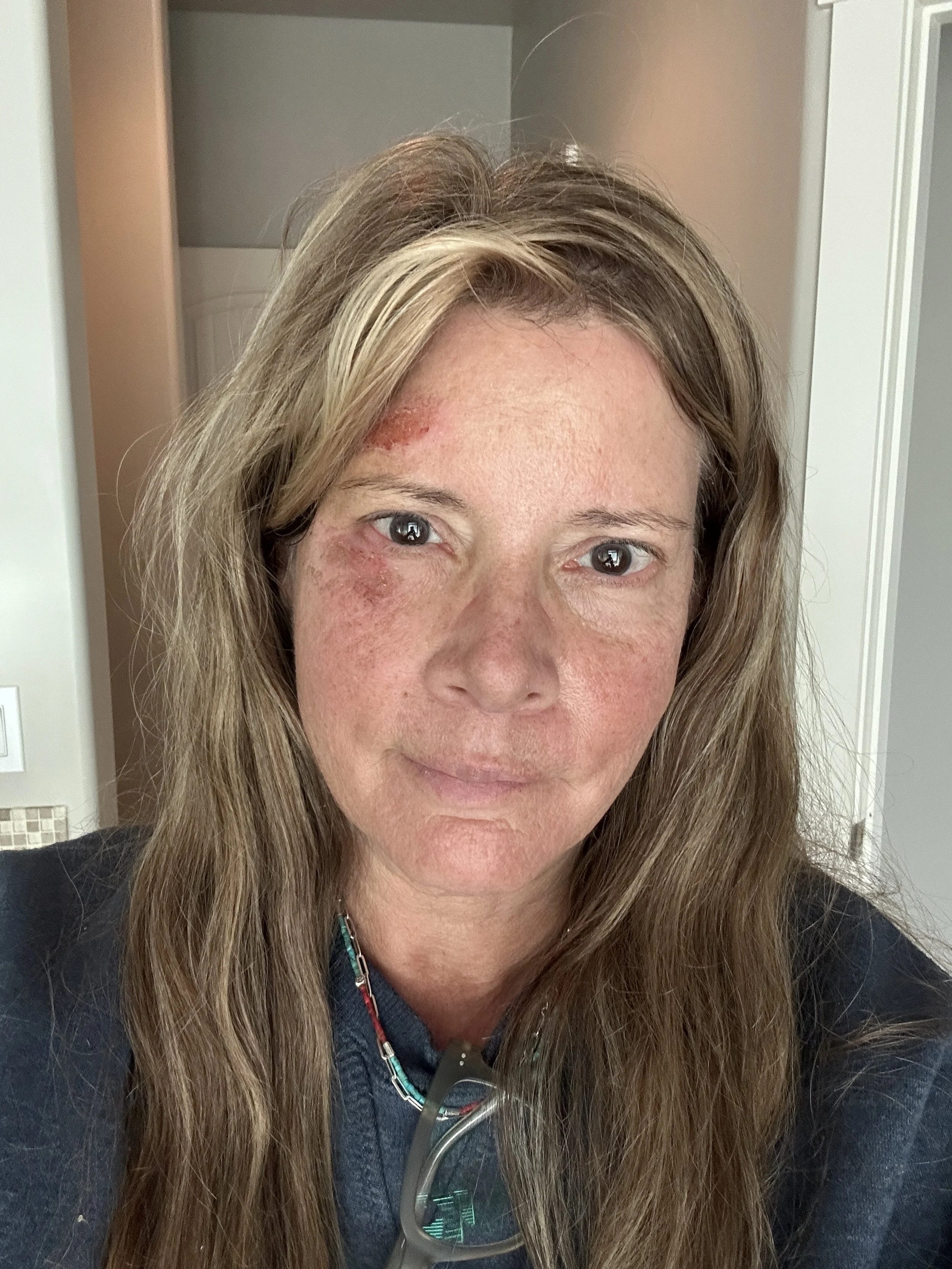  Natural skin healing results by day five using Rancher's Daughter's tallow cream