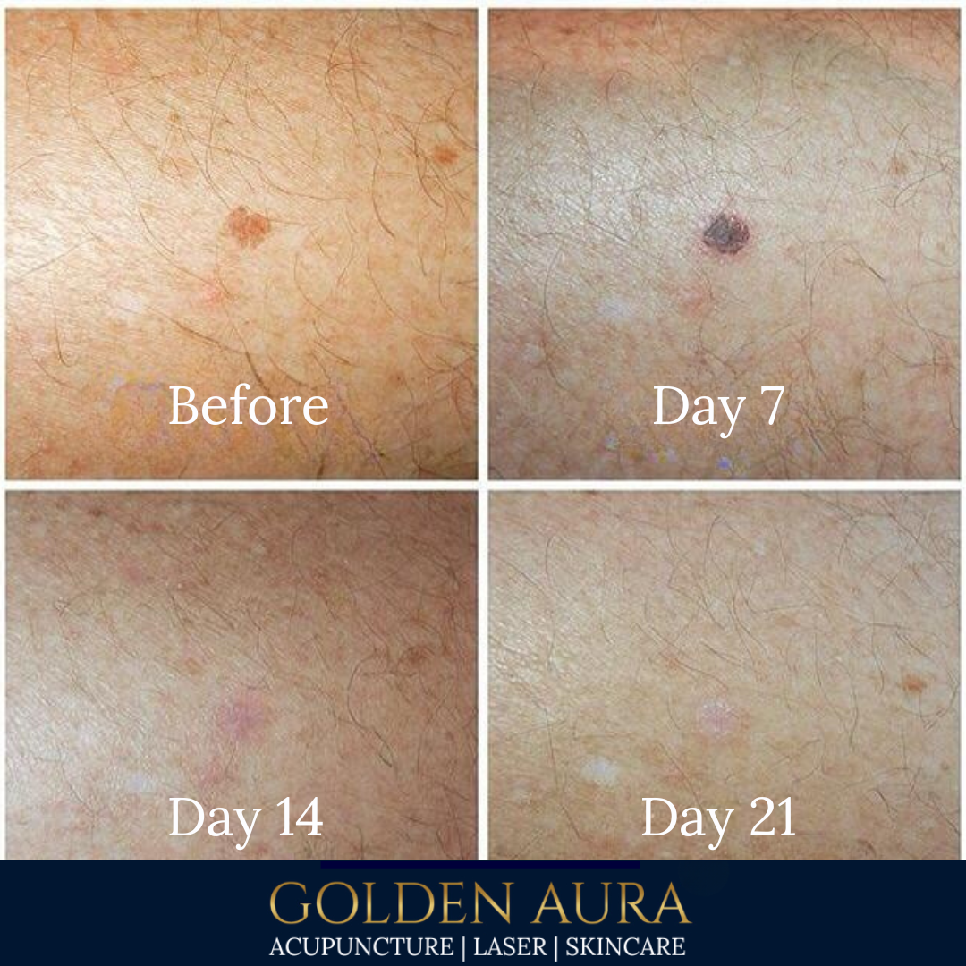 Copy of Copy of Underarm LHR before and after.png